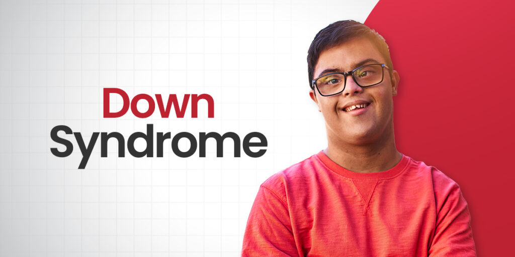 Down-Syndrome 1 A Child with Down syndrome