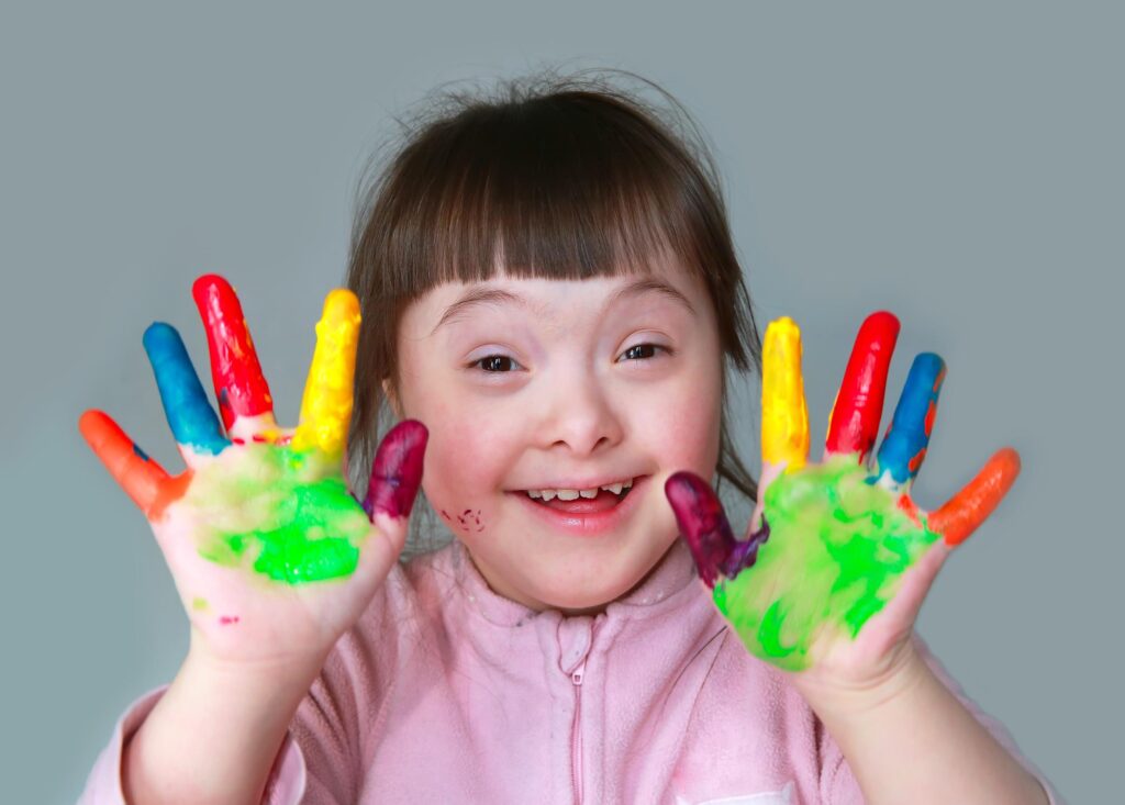 DownSyndrome 2 A Child with Down syndrome